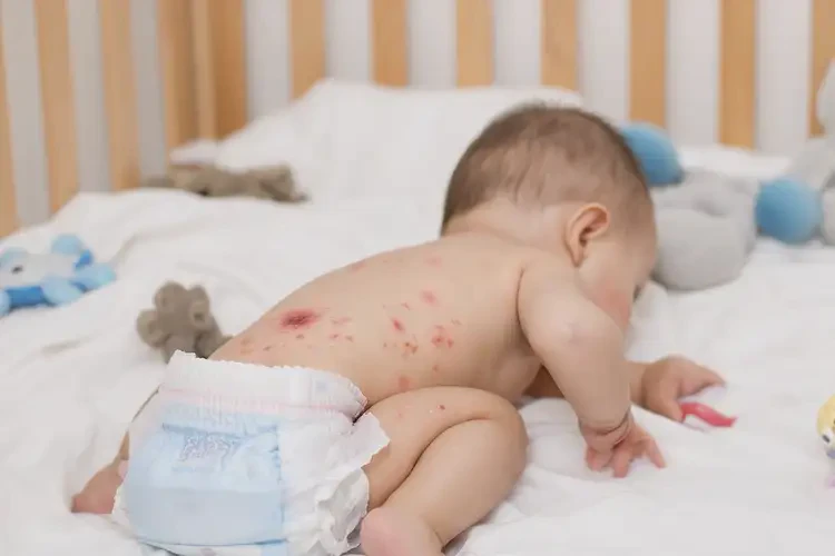 嬰幼兒屁股上有濕疹能靠自己自愈嗎(圖4)