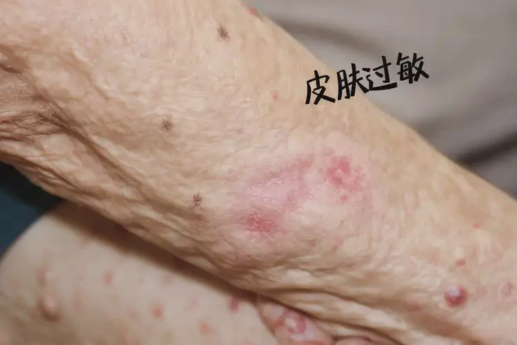 老年人手臂上容易起濕疹可不可以徹底自愈(圖4)