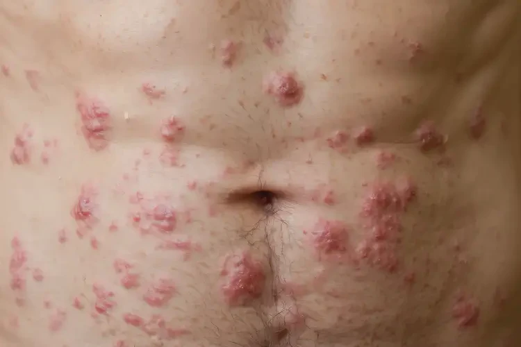 男性肚子有濕疹不管它會自己自愈嗎(圖4)