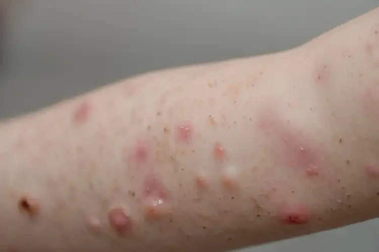 儿童手臂容易起湿疹能彻底自愈吗(图3)