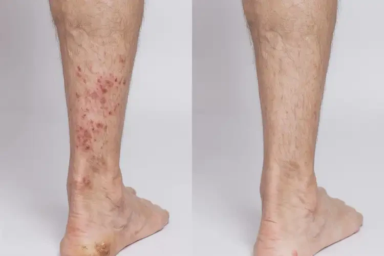 老年人脚上起湿疹不管它会自己好吗(图2)