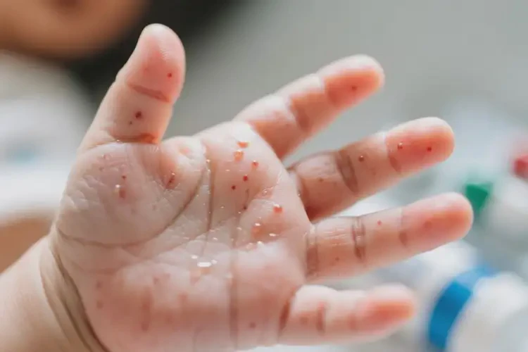 嬰兒手上長(zhǎng)濕疹可不可以根治(圖4)