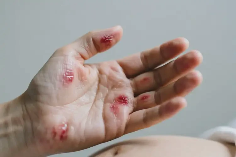 產(chǎn)婦手上經(jīng)常長濕疹不管它會自己痊愈嗎(圖3)