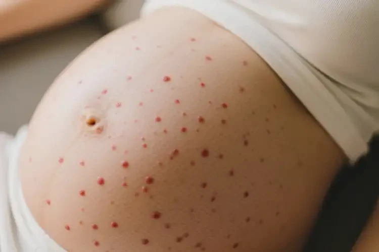 產(chǎn)婦肚子偶爾長濕疹能徹底自愈嗎(圖2)