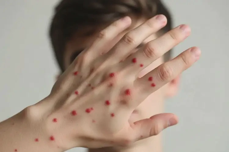 男生手上偶爾起濕疹不管它會(huì)自己好嗎(圖2)