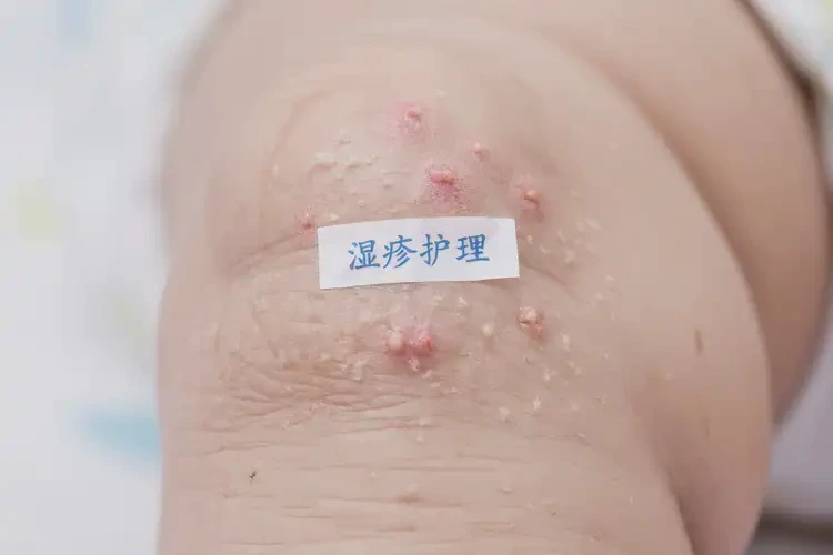 嬰幼兒小腿上起濕疹可不可以根治(圖4)