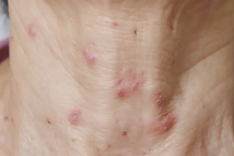 女性脖子上起濕疹可不可以徹底自愈(圖4)