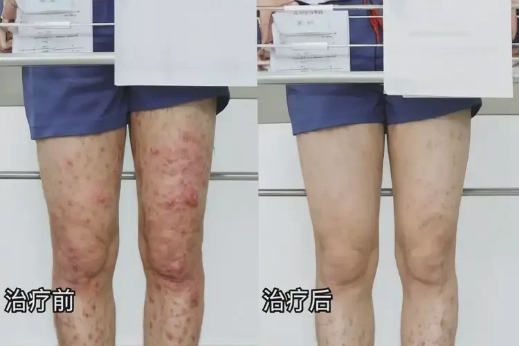 中學(xué)生大腿有濕疹可不可以徹底自愈(圖2)