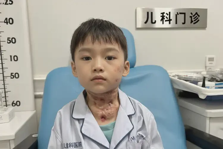 孩子脖子起濕疹可不可以徹底自愈(圖1)