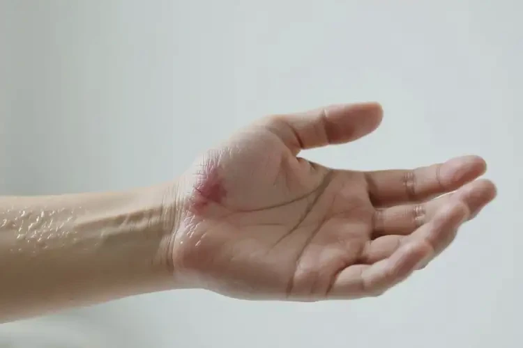 男人手臂上經(jīng)常長(zhǎng)濕疹能不能根治(圖4)