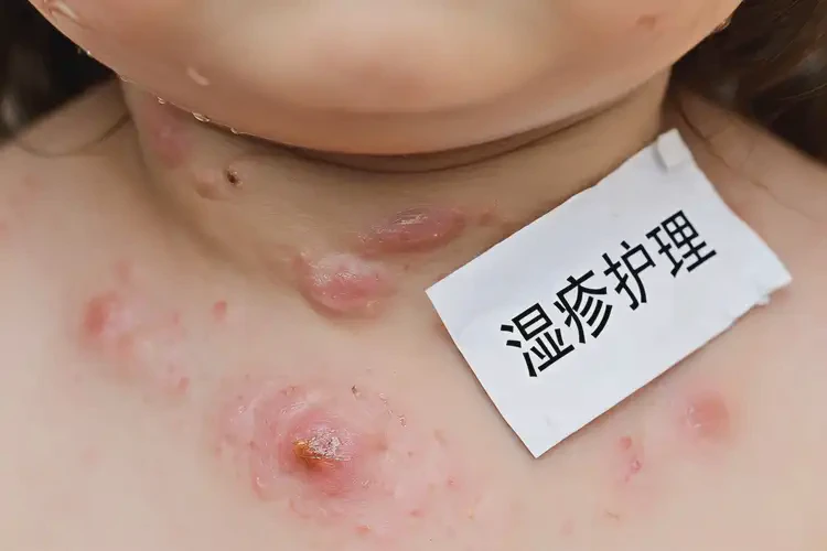 少兒脖子上經(jīng)常長濕疹可不可以根治(圖4)