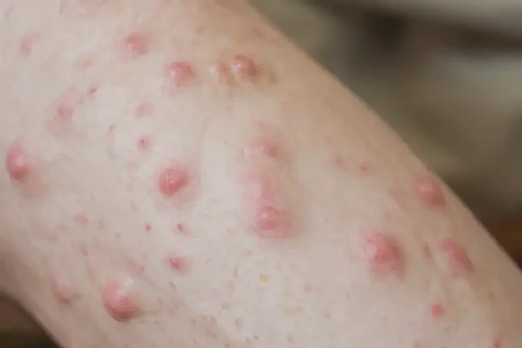 老年人小腿上經(jīng)常起濕疹不管它會(huì)自己自愈嗎(圖4)