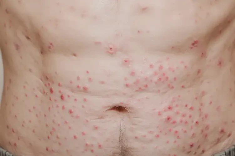 老年人肚子經(jīng)常長濕疹不管它會自己自愈嗎(圖4)