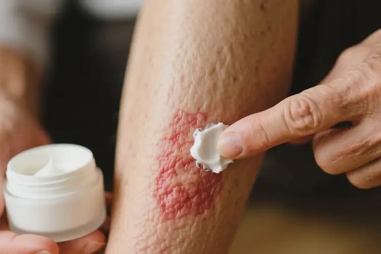 老人小腿上偶爾長濕疹可不可以根治(圖3)