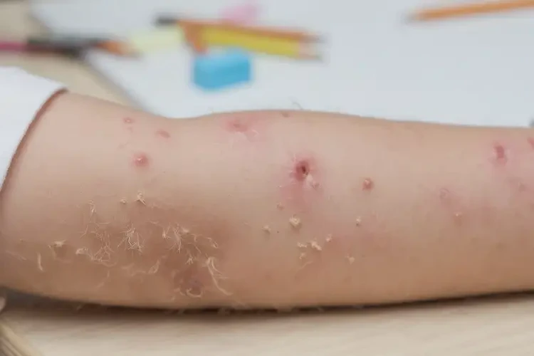 小學(xué)生手臂長濕疹不管它會自己好嗎(圖3)