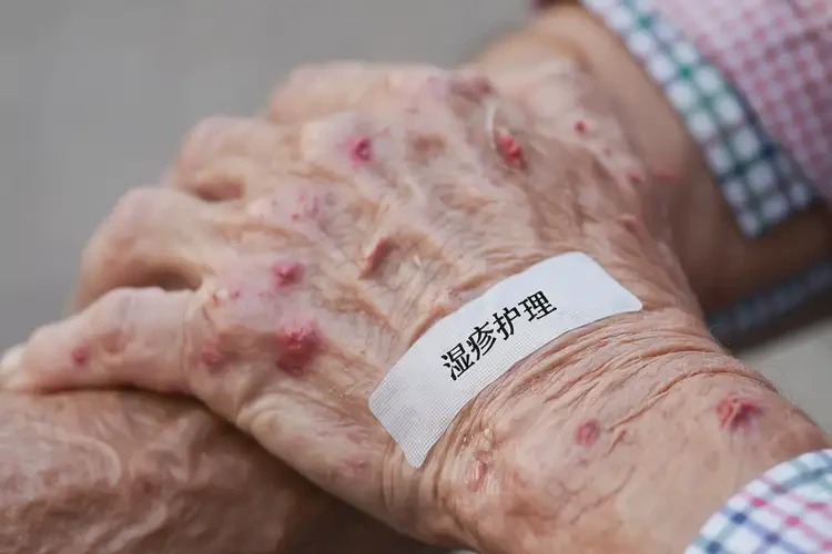 老年人屁股上偶爾長濕疹可以徹底自愈嗎(圖4)