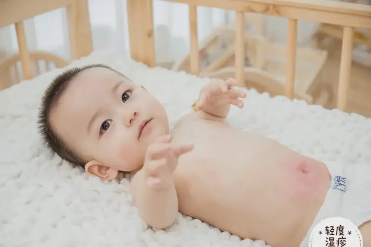 寶寶肚子上出現(xiàn)濕疹可以徹底自愈嗎(圖4)