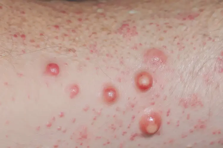 女人身上长湿疹能彻底自愈吗(图4)