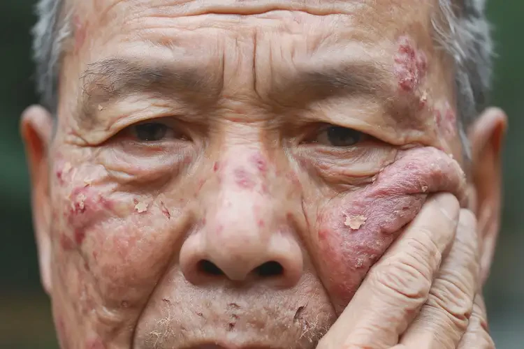 老人面部有濕疹能靠自己自愈嗎(圖4)