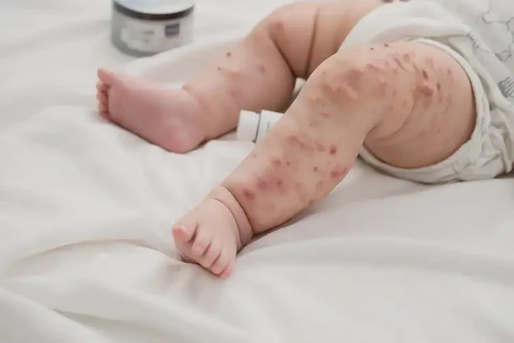 嬰幼兒大腿上出現(xiàn)濕疹可不可以徹底自愈(圖4)