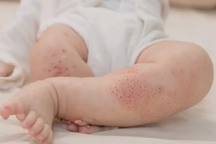 婴幼儿四肢偶尔起湿疹不管它会自己痊愈吗(图2)