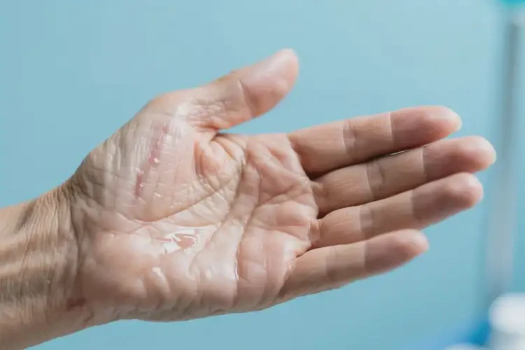 老人手上出濕疹能夠徹底治愈嗎(圖2)