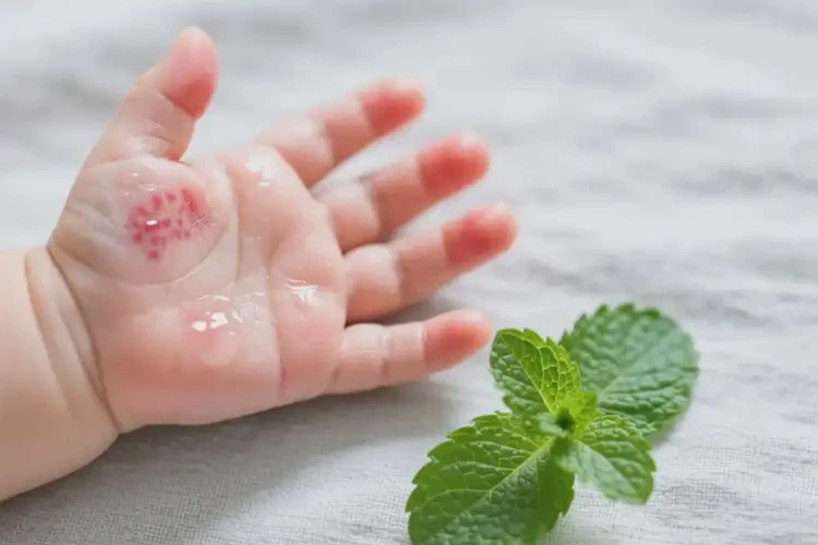 嬰幼兒手上出現(xiàn)濕疹能徹底自愈嗎(圖2)