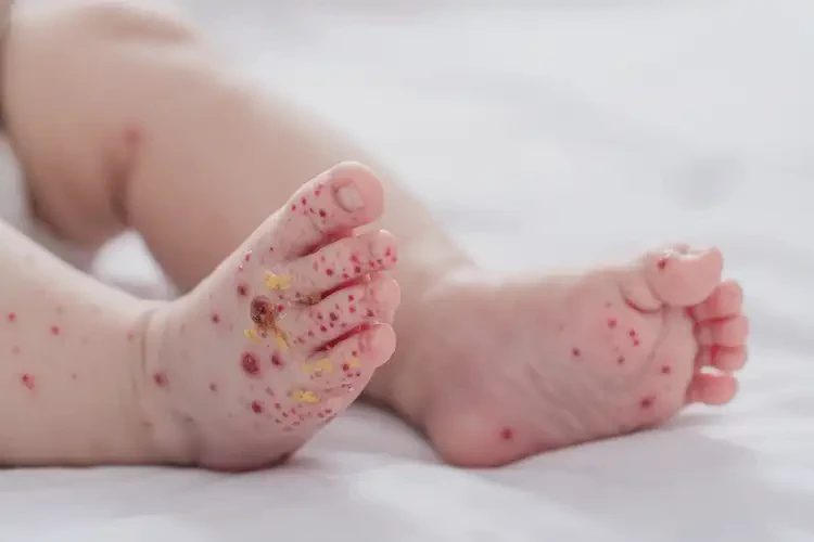 寶寶腳上容易長濕疹不管它會自己自愈嗎(圖3)