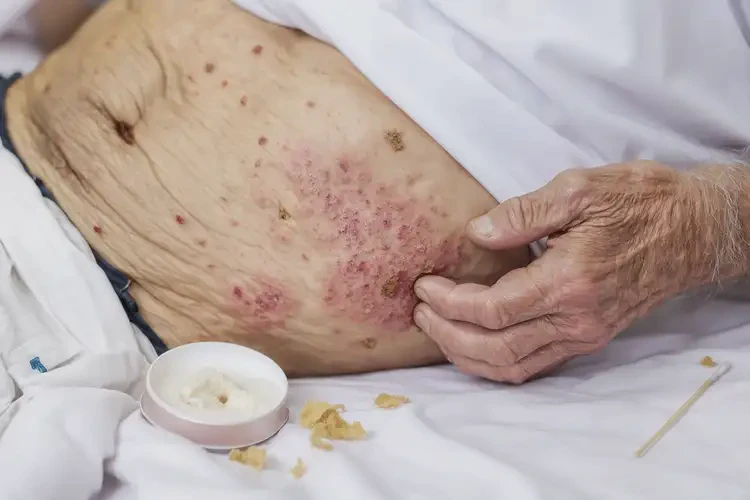 高齡老人肚子上出現(xiàn)濕疹不管它會(huì)自己痊愈嗎(圖4)