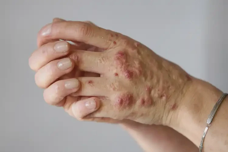 女生手上經常起濕疹不管它會自己痊愈嗎(圖4)