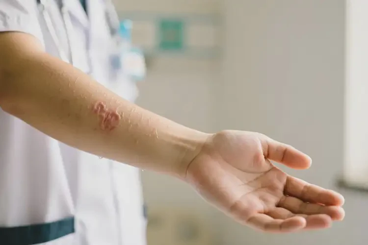 大學(xué)生手臂上長濕疹能不能徹底自愈(圖1)