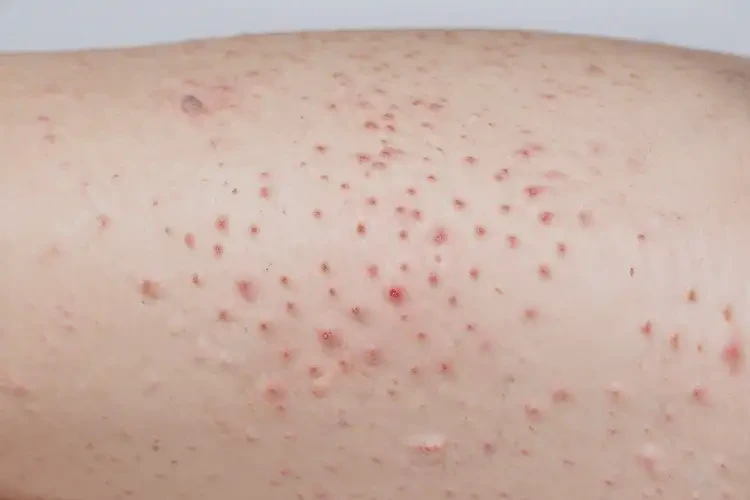 孩子大腿上经常长湿疹能彻底自愈吗(图4)