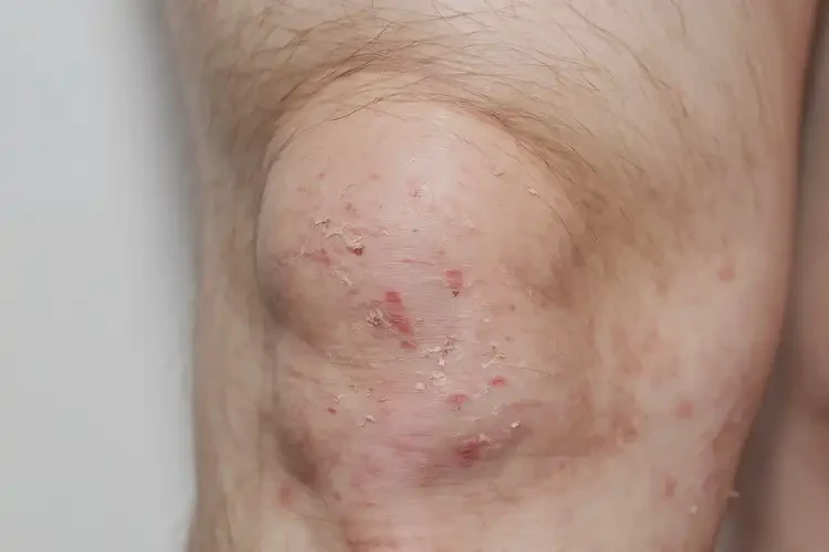 中學(xué)生大腿有濕疹可不可以徹底自愈(圖4)