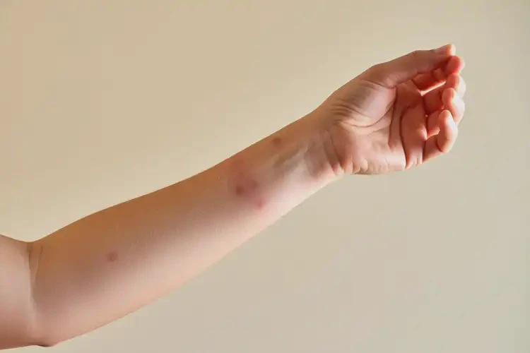 女生身上容易長濕疹可以徹底自愈嗎(圖4)