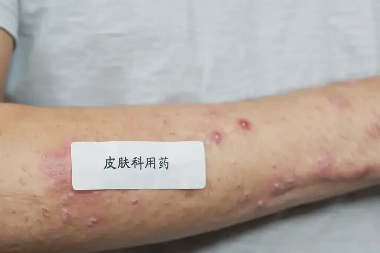 男生身上有濕疹能靠自己自愈嗎(圖4)