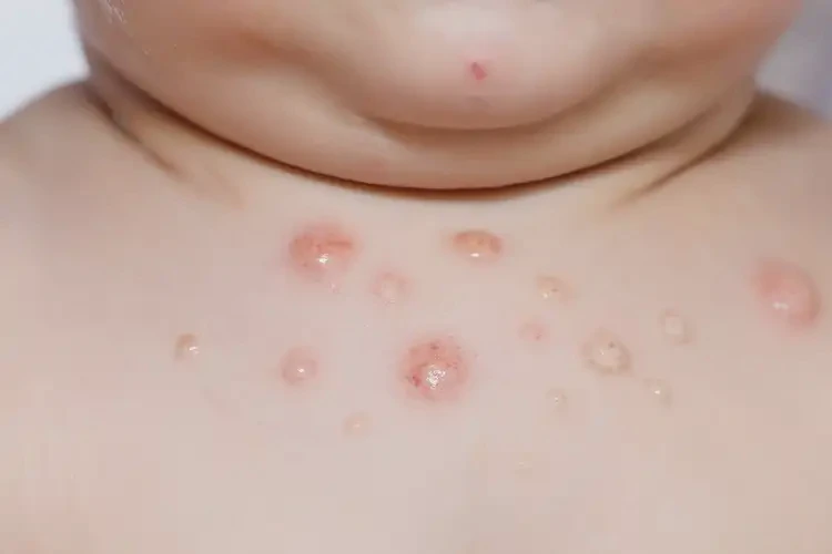 小兒脖子上出現(xiàn)濕疹不管它會(huì)自己好嗎(圖4)