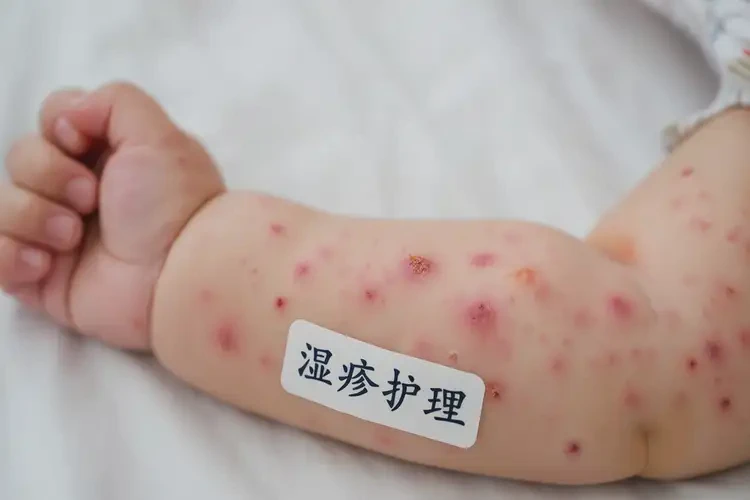 婴儿手臂上偶尔起湿疹能够彻底治愈吗(图4)