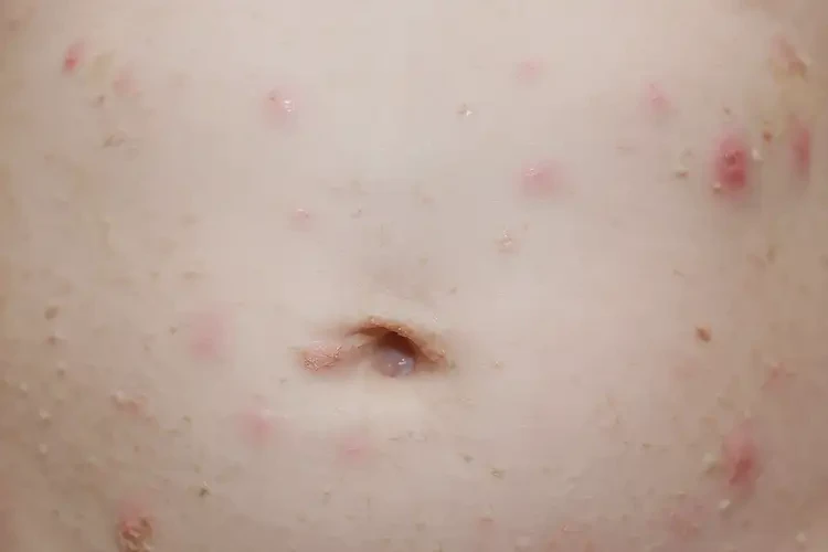 幼兒肚子上偶爾起濕疹能不能徹底自愈(圖4)