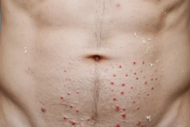 男性肚子偶爾起濕疹可以徹底自愈嗎(圖3)