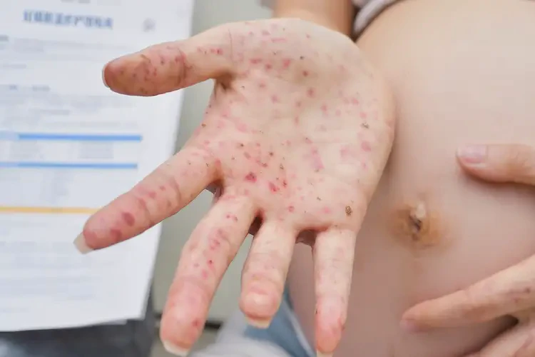 孕婦手上偶爾長濕疹可以徹底自愈嗎(圖4)