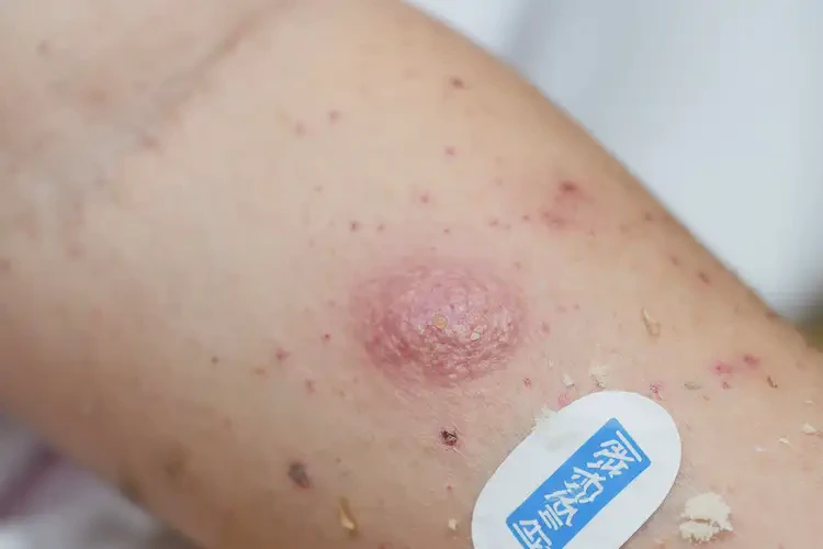 兒童手臂上出現(xiàn)濕疹可不可以根治(圖4)