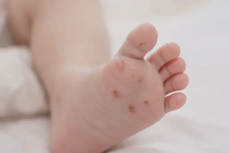 寶寶腳上容易長濕疹不管它會自己自愈嗎(圖4)