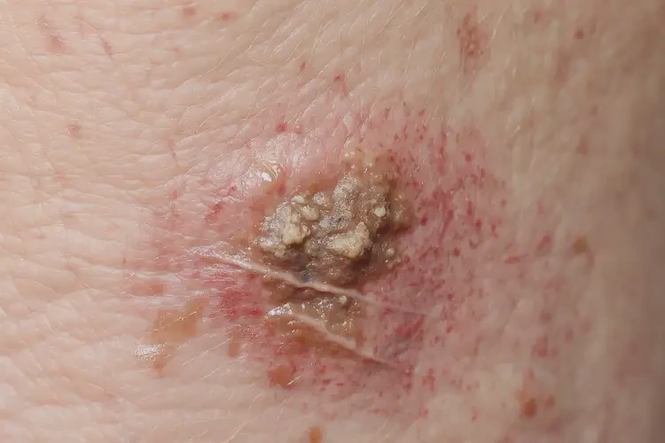 女人身上长湿疹能彻底自愈吗(图3)