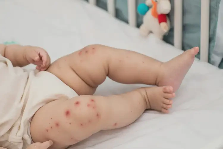 嬰幼兒大腿上偶爾起濕疹可不可以根治(圖4)