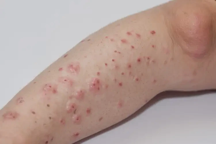 兒童全身出現(xiàn)濕疹不管它會(huì)自己自愈嗎(圖3)