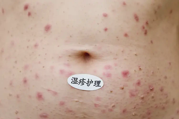 女人肚子上出濕疹能不能根治(圖4)