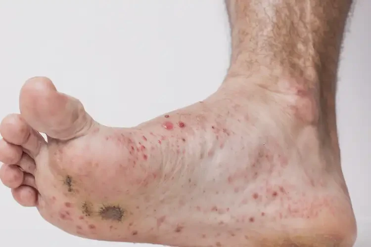 男性腳上出現(xiàn)濕疹不管它會(huì)自己自愈嗎(圖4)