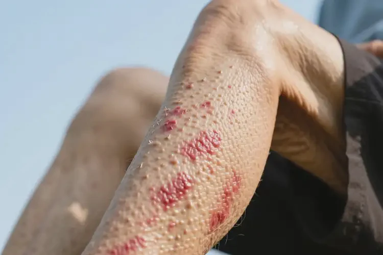 高龄老人小腿上偶尔长湿疹可以彻底自愈吗(图1)