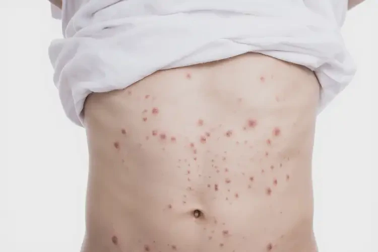 青少年肚子起濕疹能不能徹底自愈(圖4)