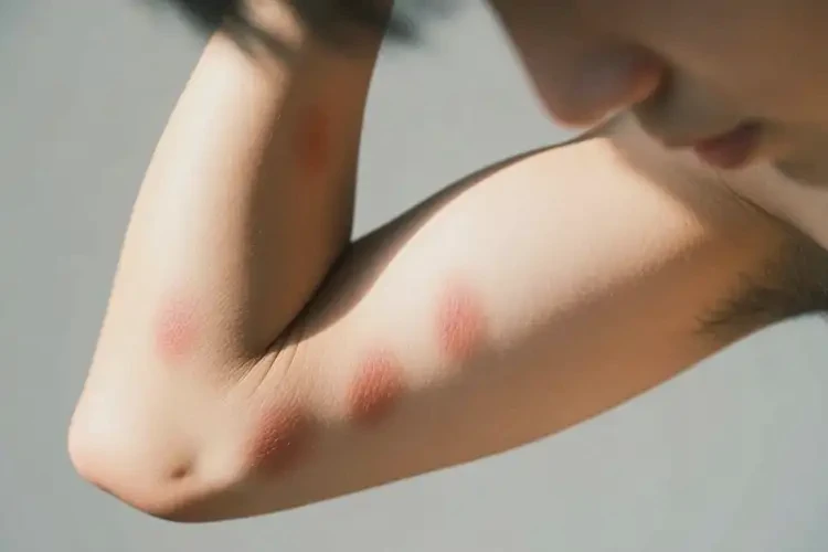 青年人手臂上經(jīng)常長濕疹不管它會自己痊愈嗎(圖4)